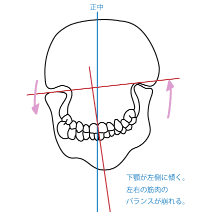 顎関節症について：図2 問題のある噛み合わせ