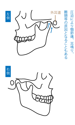 顎関節症について：図3 問題のある噛み合わせ側面