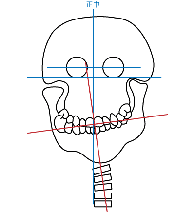 顎関節症について：図6 瞳孔線を水平にするために背骨を曲げる