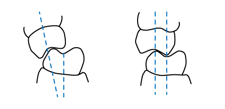 顎関節症について：図10 微調整して正常な噛み合わせになる